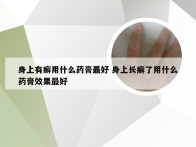 身上有癣用什么药膏最好 身上长癣了用什么药膏效果最好