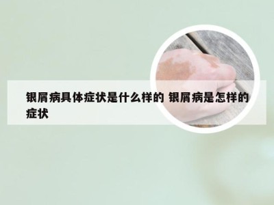 银屑病具体症状是什么样的 银屑病是怎样的症状