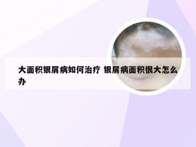 大面积银屑病如何治疗 银屑病面积很大怎么办