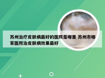 苏州治疗皮肤病最好的医院是哪里 苏州市哪家医院治皮肤病效果最好