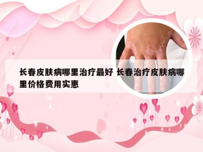 长春皮肤病哪里治疗最好 长春治疗皮肤病哪里价格费用实惠