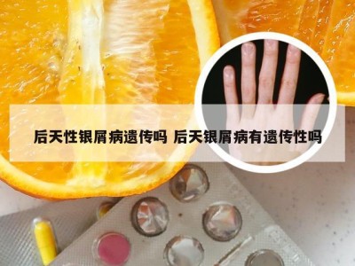 后天性银屑病遗传吗 后天银屑病有遗传性吗