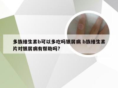 多族维生素b可以多吃吗银屑病 b族维生素片对银屑病有帮助吗?