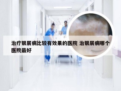 治疗银屑病比较有效果的医院 治银屑病哪个医院最好