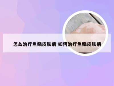 怎么治疗鱼鳞皮肤病 如何治疗鱼鳞皮肤病