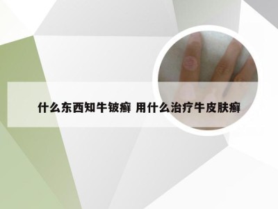 什么东西知牛铍癣 用什么治疗牛皮肤癣