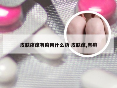 皮肤瘙痒有癣用什么药 皮肤痒,有癣