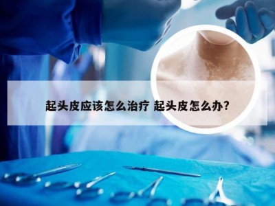 起头皮应该怎么治疗 起头皮怎么办?