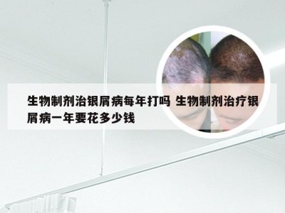 生物制剂治银屑病每年打吗 生物制剂治疗银屑病一年要花多少钱