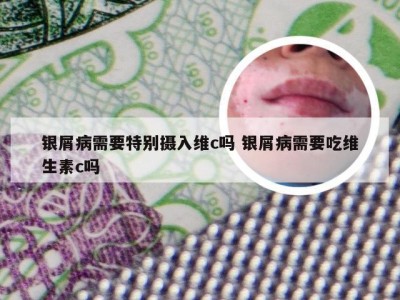 银屑病需要特别摄入维c吗 银屑病需要吃维生素c吗