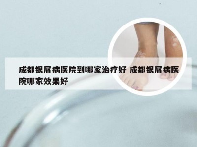 成都银屑病医院到哪家治疗好 成都银屑病医院哪家效果好