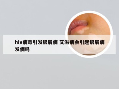 hiv病毒引发银屑病 艾滋病会引起银屑病发病吗