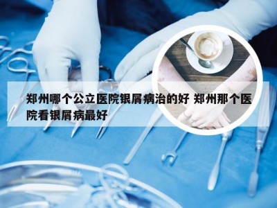 郑州哪个公立医院银屑病治的好 郑州那个医院看银屑病最好