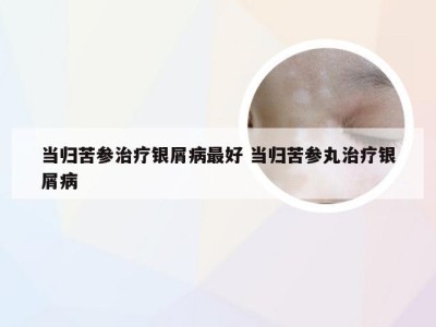 当归苦参治疗银屑病最好 当归苦参丸治疗银屑病