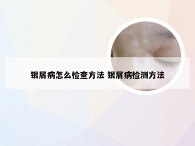 银屑病怎么检查方法 银屑病检测方法