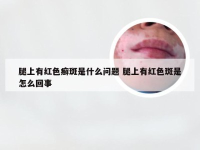 腿上有红色癣斑是什么问题 腿上有红色斑是怎么回事