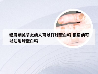 银屑病关节炎病人可以打球蛋白吗 银屑病可以注射球蛋白吗