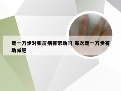 走一万步对银屑病有帮助吗 每次走一万步有助减肥