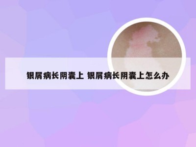 银屑病长阴囊上 银屑病长阴囊上怎么办