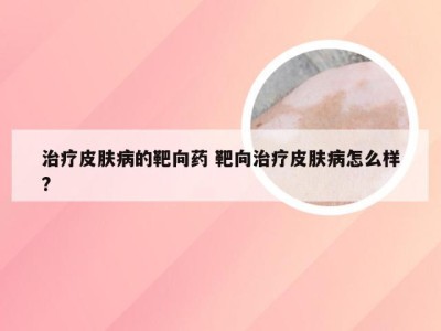 治疗皮肤病的靶向药 靶向治疗皮肤病怎么样?