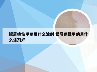 银屑病性甲病用什么涂剂 银屑病性甲病用什么涂剂好