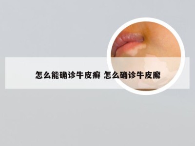 怎么能确诊牛皮癣 怎么确诊牛皮廨