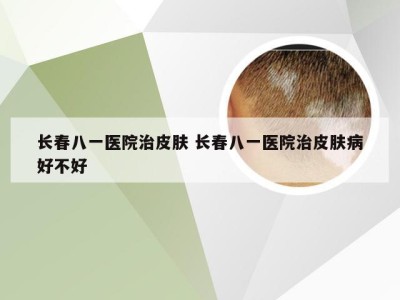 长春八一医院治皮肤 长春八一医院治皮肤病好不好