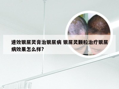 速效银屑灵膏治银屑病 银屑灵颗粒治疗银屑病效果怎么样?