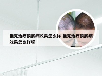 强克治疗银屑病效果怎么样 强克治疗银屑病效果怎么样呀