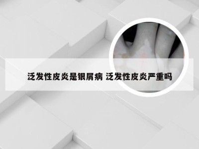 泛发性皮炎是银屑病 泛发性皮炎严重吗