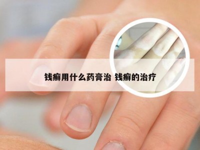 钱癣用什么药膏治 钱癣的治疗