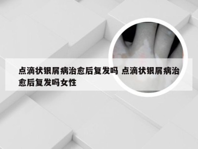 点滴状银屑病治愈后复发吗 点滴状银屑病治愈后复发吗女性