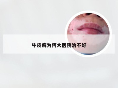 牛皮癣为何大医院治不好