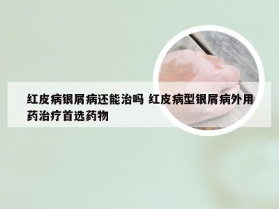 红皮病银屑病还能治吗 红皮病型银屑病外用药治疗首选药物