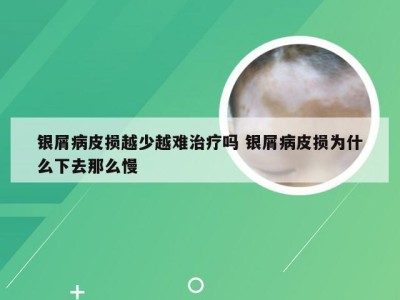 银屑病皮损越少越难治疗吗 银屑病皮损为什么下去那么慢