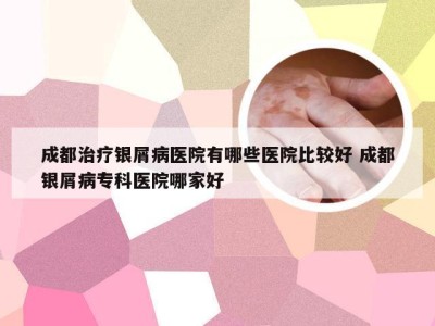 成都治疗银屑病医院有哪些医院比较好 成都银屑病专科医院哪家好