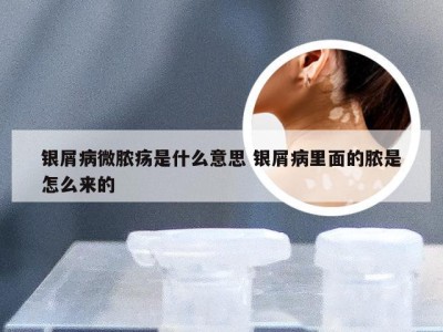 银屑病微脓疡是什么意思 银屑病里面的脓是怎么来的