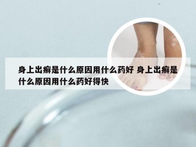 身上出癣是什么原因用什么药好 身上出癣是什么原因用什么药好得快