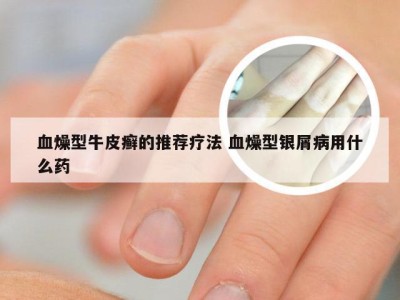 血燥型牛皮癣的推荐疗法 血燥型银屑病用什么药