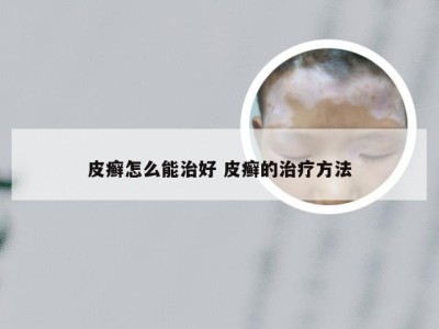 皮癣怎么能治好 皮癣的治疗方法