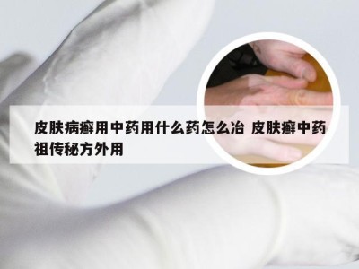 皮肤病癣用中药用什么药怎么冶 皮肤癣中药祖传秘方外用