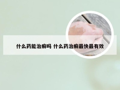 什么药能治癣吗 什么药治癣最快最有效