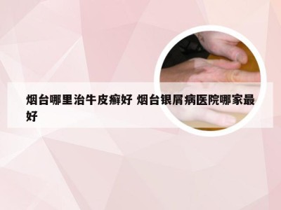 烟台哪里治牛皮癣好 烟台银屑病医院哪家最好