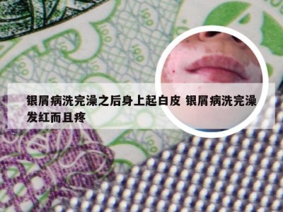 银屑病洗完澡之后身上起白皮 银屑病洗完澡发红而且疼