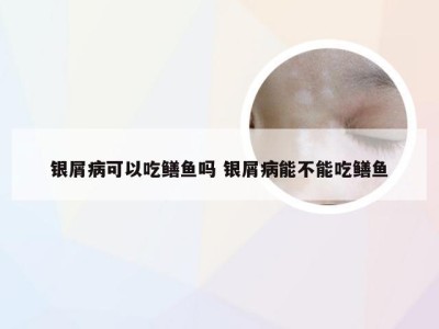 银屑病可以吃鳝鱼吗 银屑病能不能吃鳝鱼