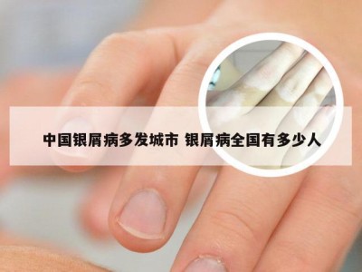 中国银屑病多发城市 银屑病全国有多少人