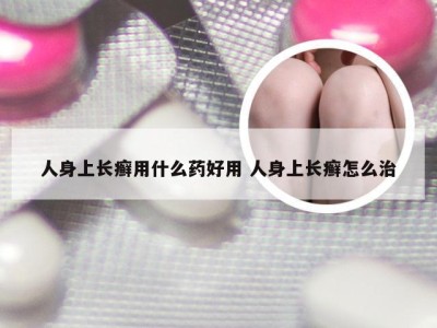 人身上长癣用什么药好用 人身上长癣怎么治