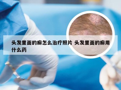 头发里面的癣怎么治疗照片 头发里面的癣用什么药