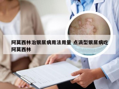 阿莫西林治银屑病用法用量 点滴型银屑病吃阿莫西林