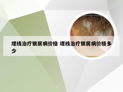 埋线治疗银屑病价格 埋线治疗银屑病价格多少